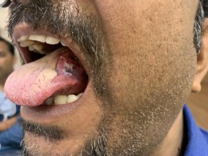 Tongue and mouth cancer